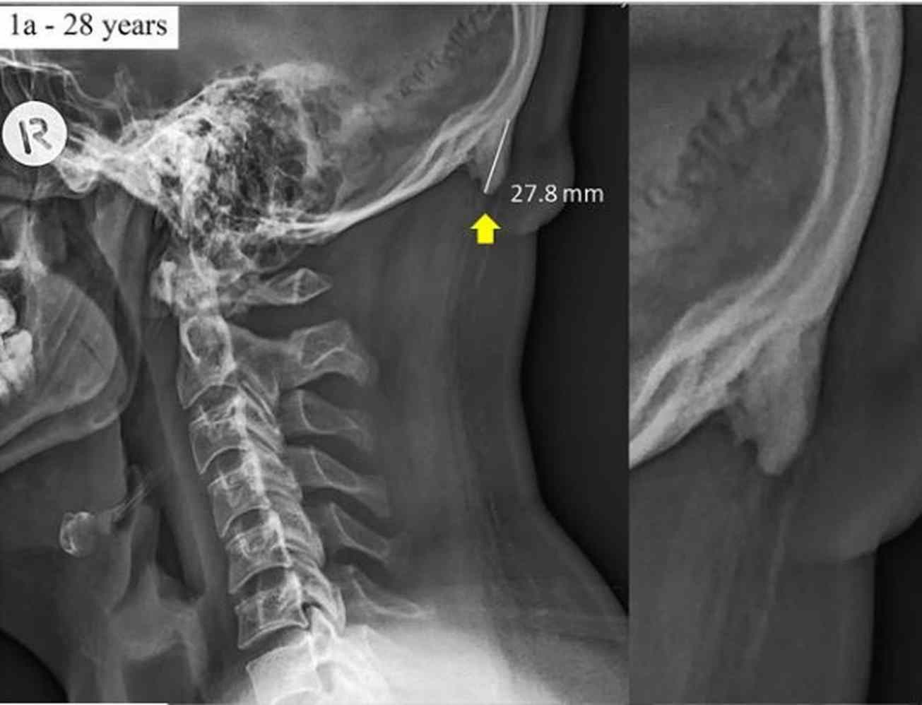 Cientistas afirmam que uso de celular pode gerar “chifre” no crânio