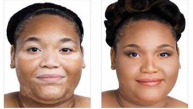 cura para vitiligo