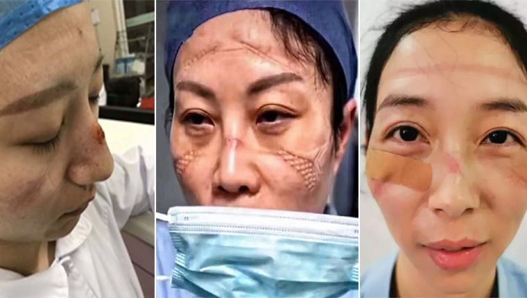 médicos com rostos marcados por máscaras