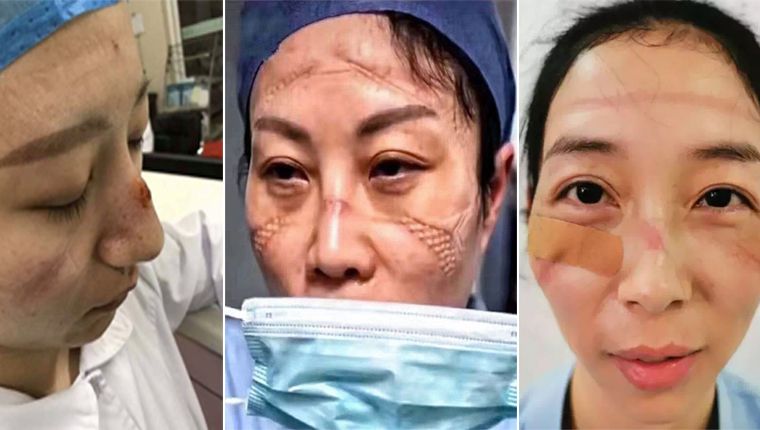 China: Fotos de médicos e enfermeiros com rostos feridos pelo uso contínuo de máscaras viralizam
