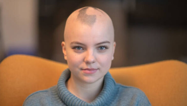o que é alopecia