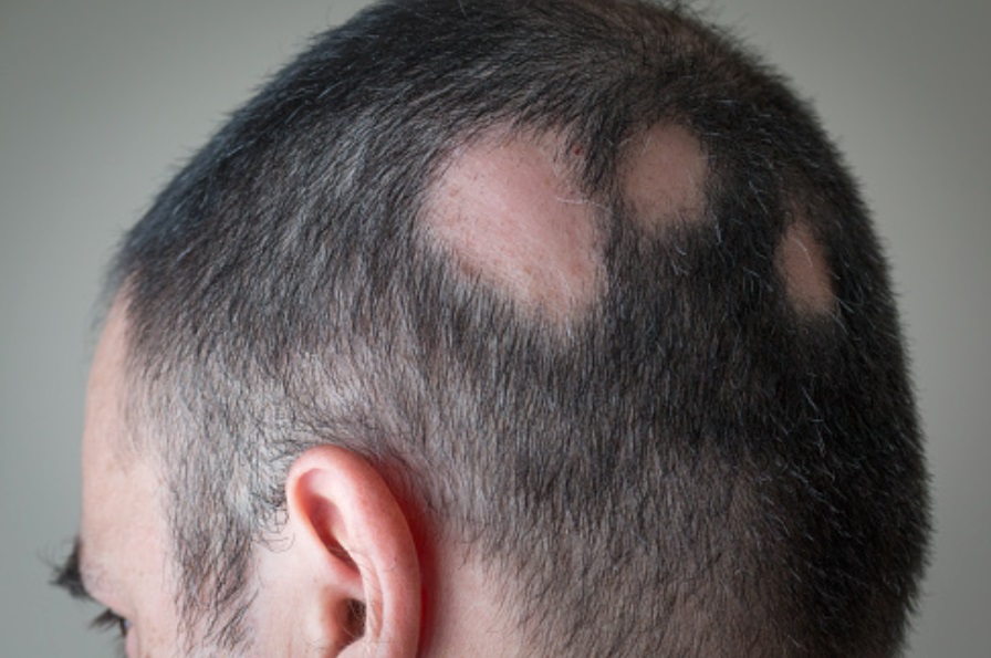 o que é alopecia tratamento